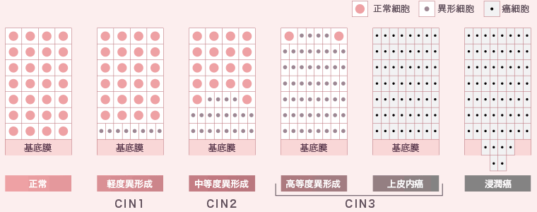 図：子宮頸部扁平上皮系病変